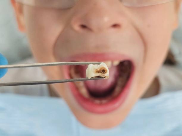 Best Emergency Tooth Extraction in Moss Beach, CA